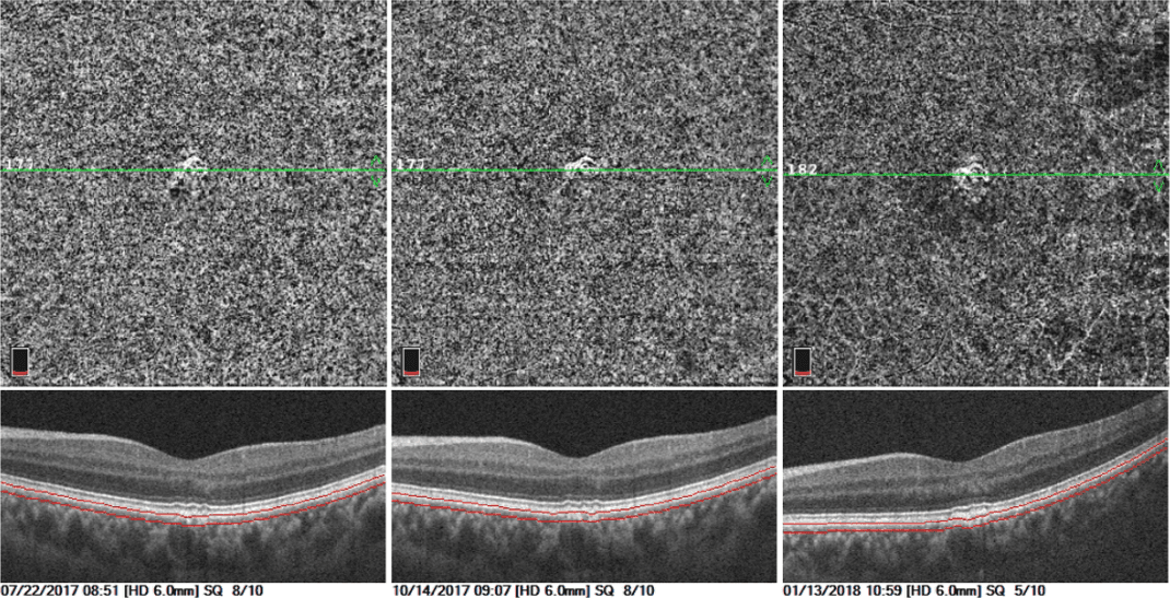 Cnv Macula Oct 5 Line Exposing Hidden Lesions: A Case of Non-Exudative Occult CNV