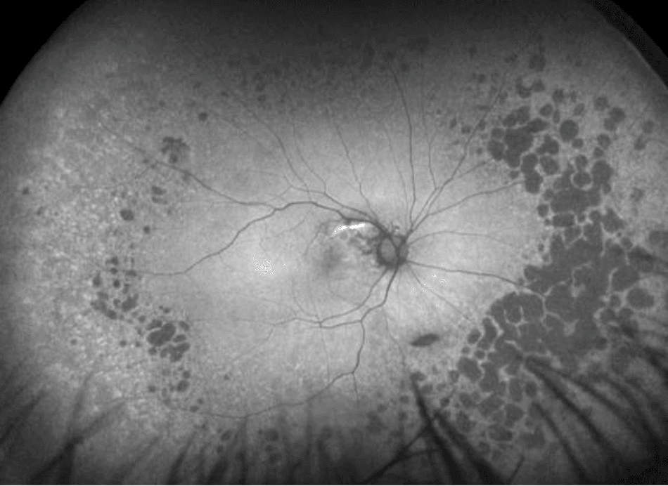 The Wide Spectrum of Peripheral Retinal Disease in AMD