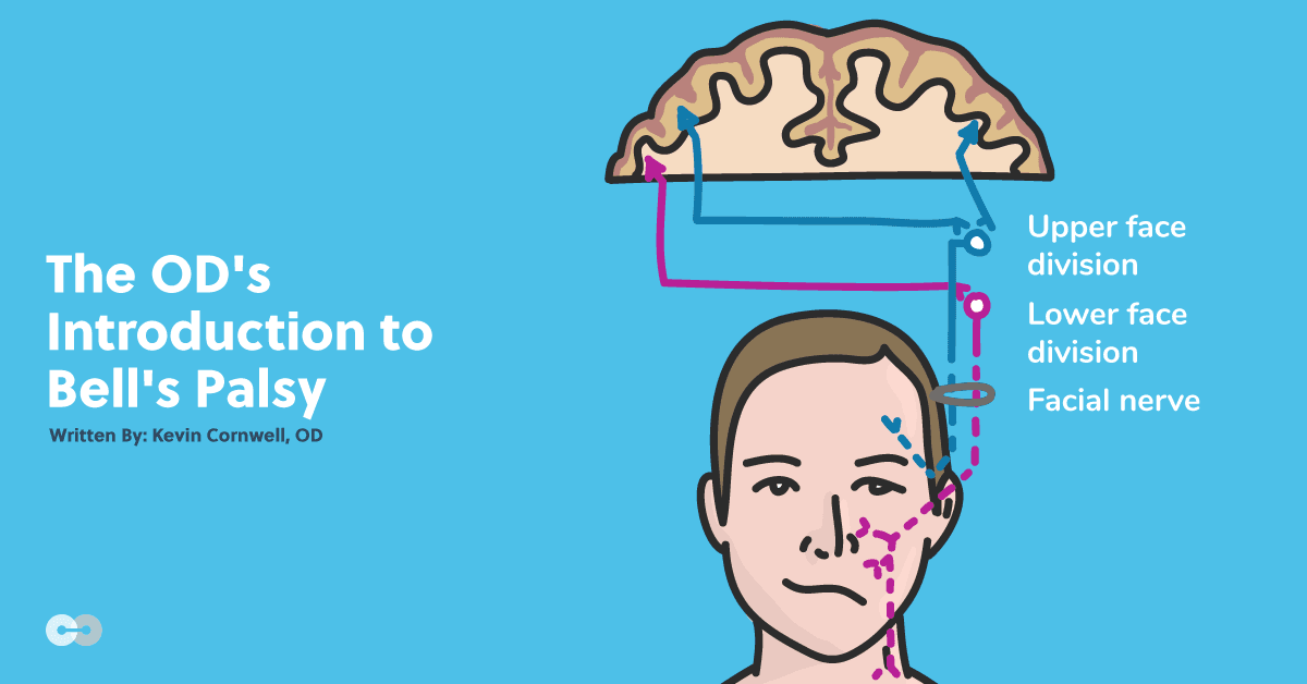 Bell's Reflex The OD's Introduction to Bell's Palsy