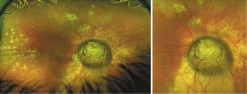 A Guide to Optic Disc Abnormalities with Cheat Sheet