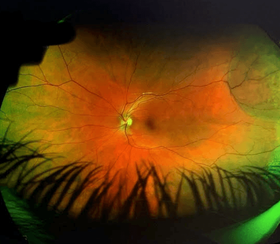 Retinal Band The OD's Guide to Identifying Peripheral Retinal Disease with Cheat Sheet