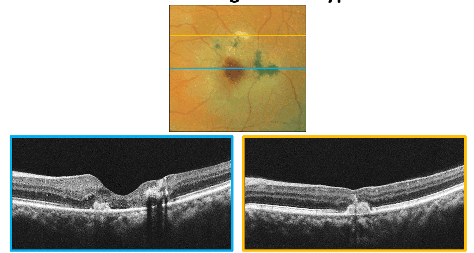 OCT Angiography: Routine to Extreme