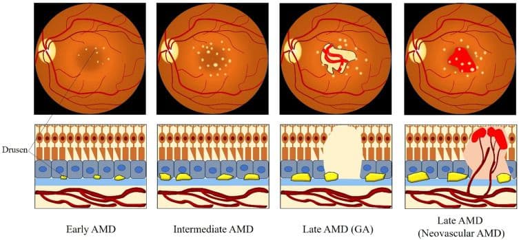 5 Clinical Pearls for Monitoring AMD Progression