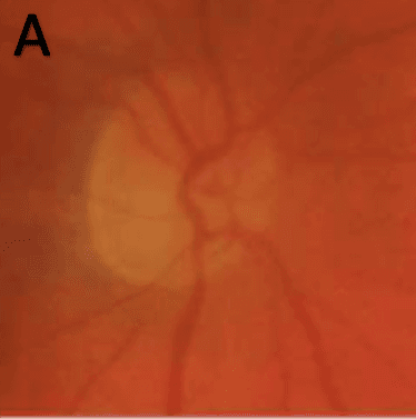 A Guide to Optic Disc Abnormalities with Cheat Sheet