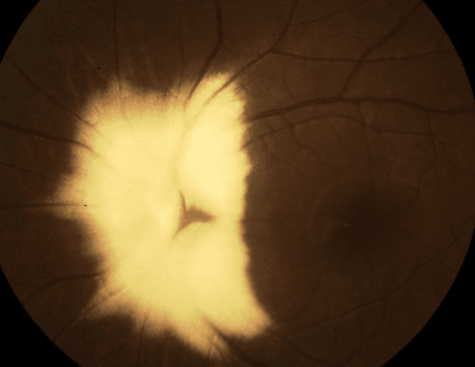 A Guide to Optic Disc Abnormalities with Cheat Sheet