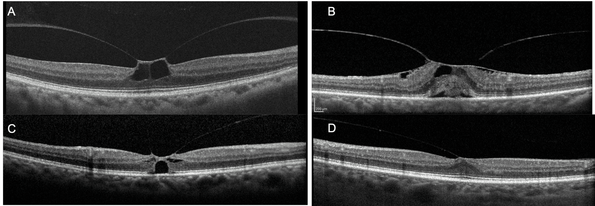 Vmt Classification Step-by-Step Review and Pearls for Macular Hole Staging with Cheat Sheet