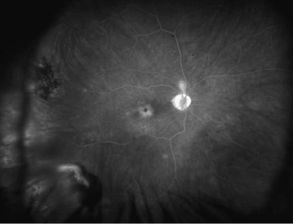 The Wide Spectrum of Peripheral Retinal Disease in AMD