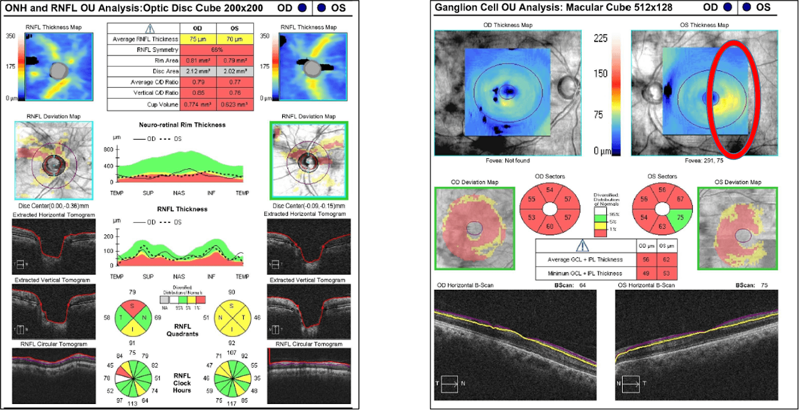 Zeizz Oct Rnfl Redefining Early Detection - The ZEISS CIRRUS 6000 is Intelligently ...