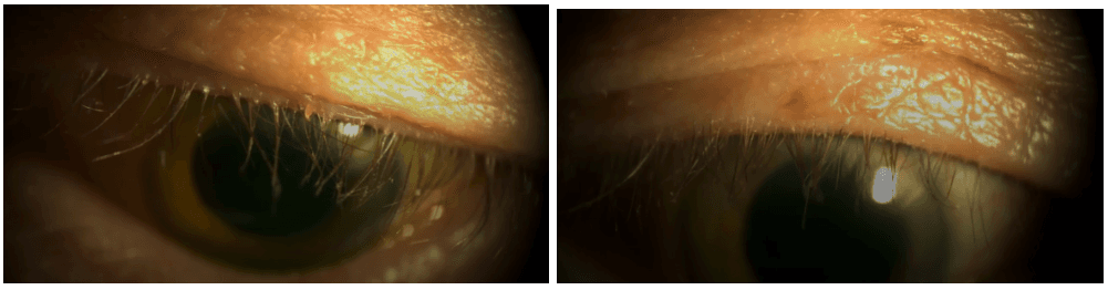 Collarette Scale Optometry Current and Emerging Targeted Pharmacologic Therapies for Dry Eye with ...