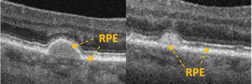 Fluid Under Rpe Into the Woods: Interpreting OCT Imaging in Retinal Disease