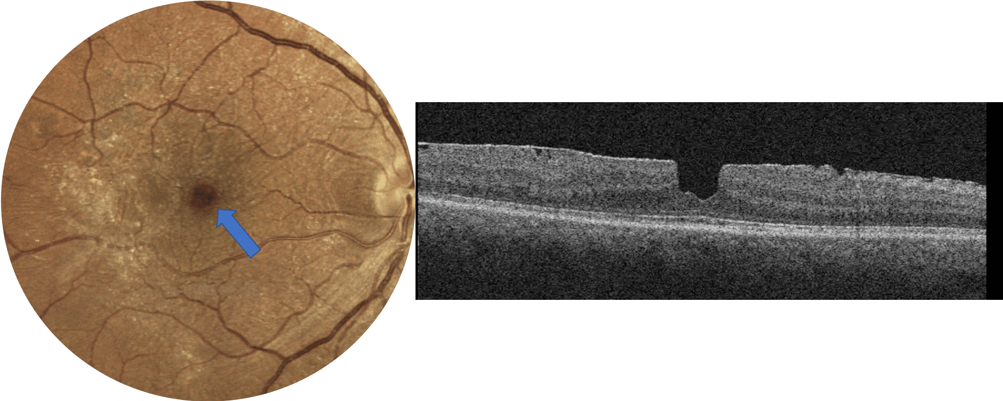 Colpite Macular Step-by-Step Review and Pearls for Macular Hole Staging with Cheat Sheet