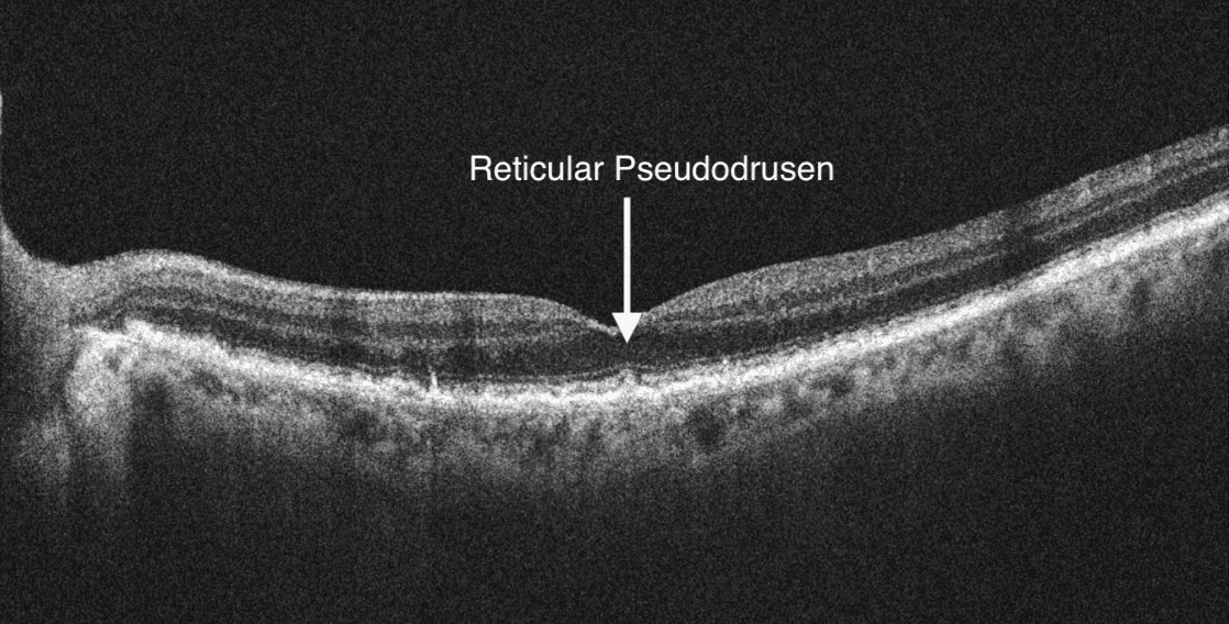 Oct Defect Above Rpe How To Accurately Stage Age-Related Macular Degeneration with Cheat Sheet