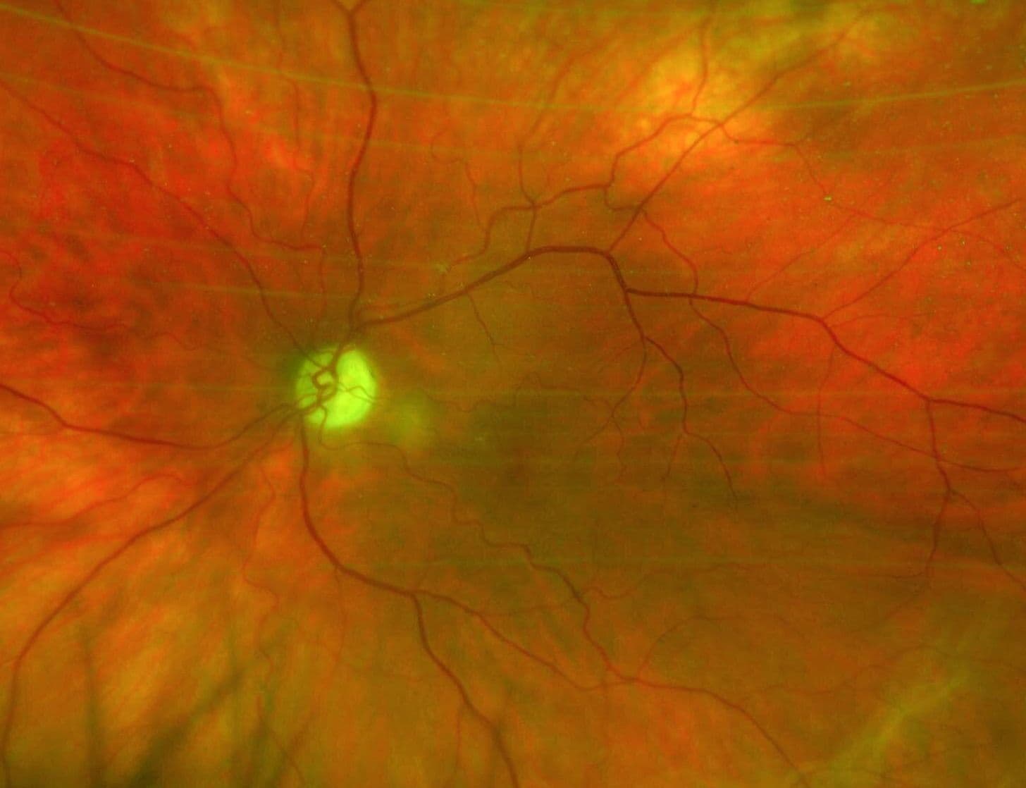 A Guide to Non-Glaucomatous Optic Nerve Disease
