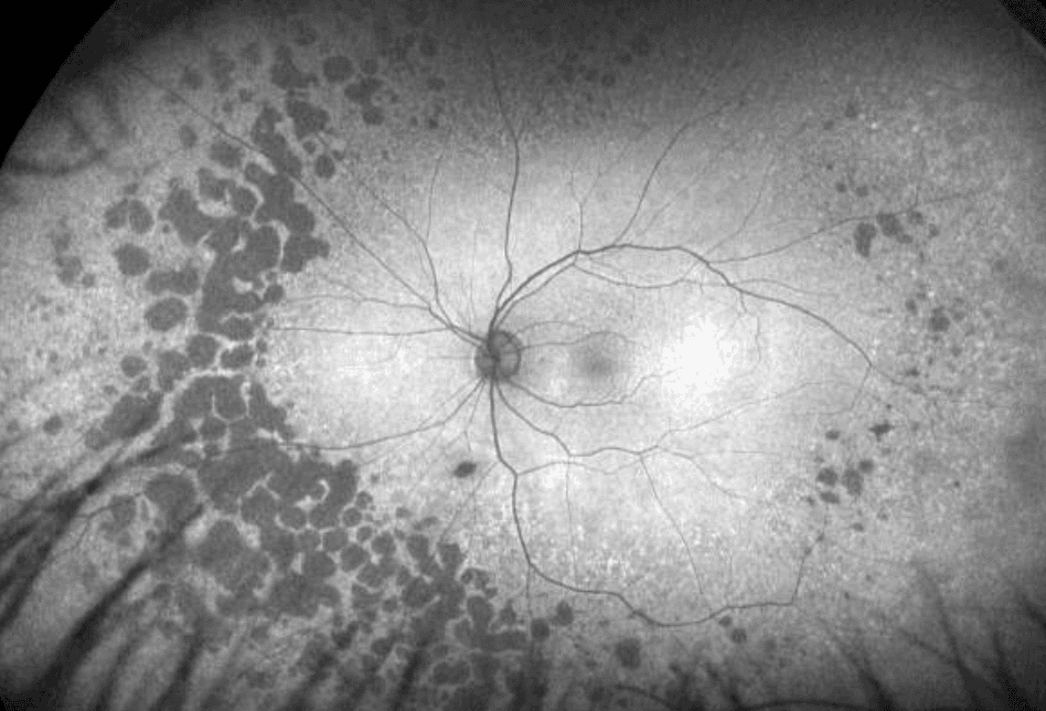 The Wide Spectrum of Peripheral Retinal Disease in AMD