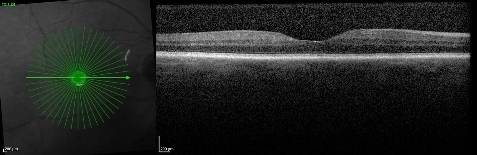 Pseudophakic Cystoid Macular Edema: What to Do and When to Refer