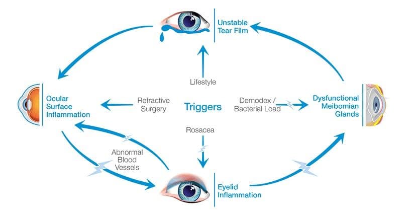 The Ultimate Guide to OptiLight for Dry Eye