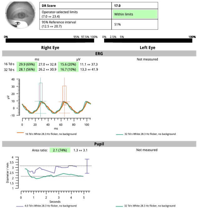 Erg Report A Tale of Two Patients: How ERG Uncovered Hidden Diabetic Retinopathy ...
