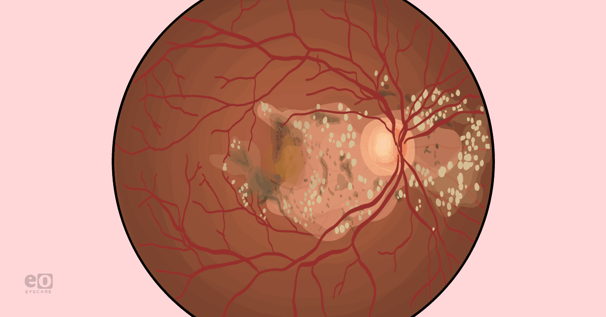 The Ophthalmology Resident's Guide to Inherited Macular Dystrophies ...