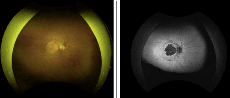 How to Identify Geographic Atrophy Early with Multimodal Imaging