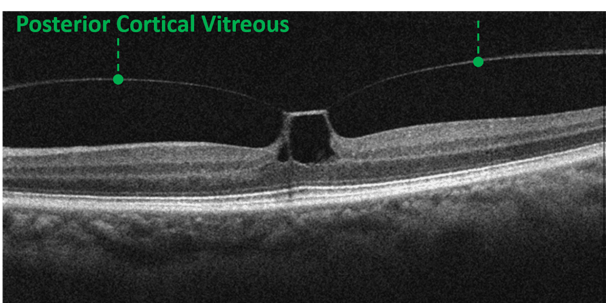 Into the Woods: Interpreting OCT Imaging in Retinal Disease