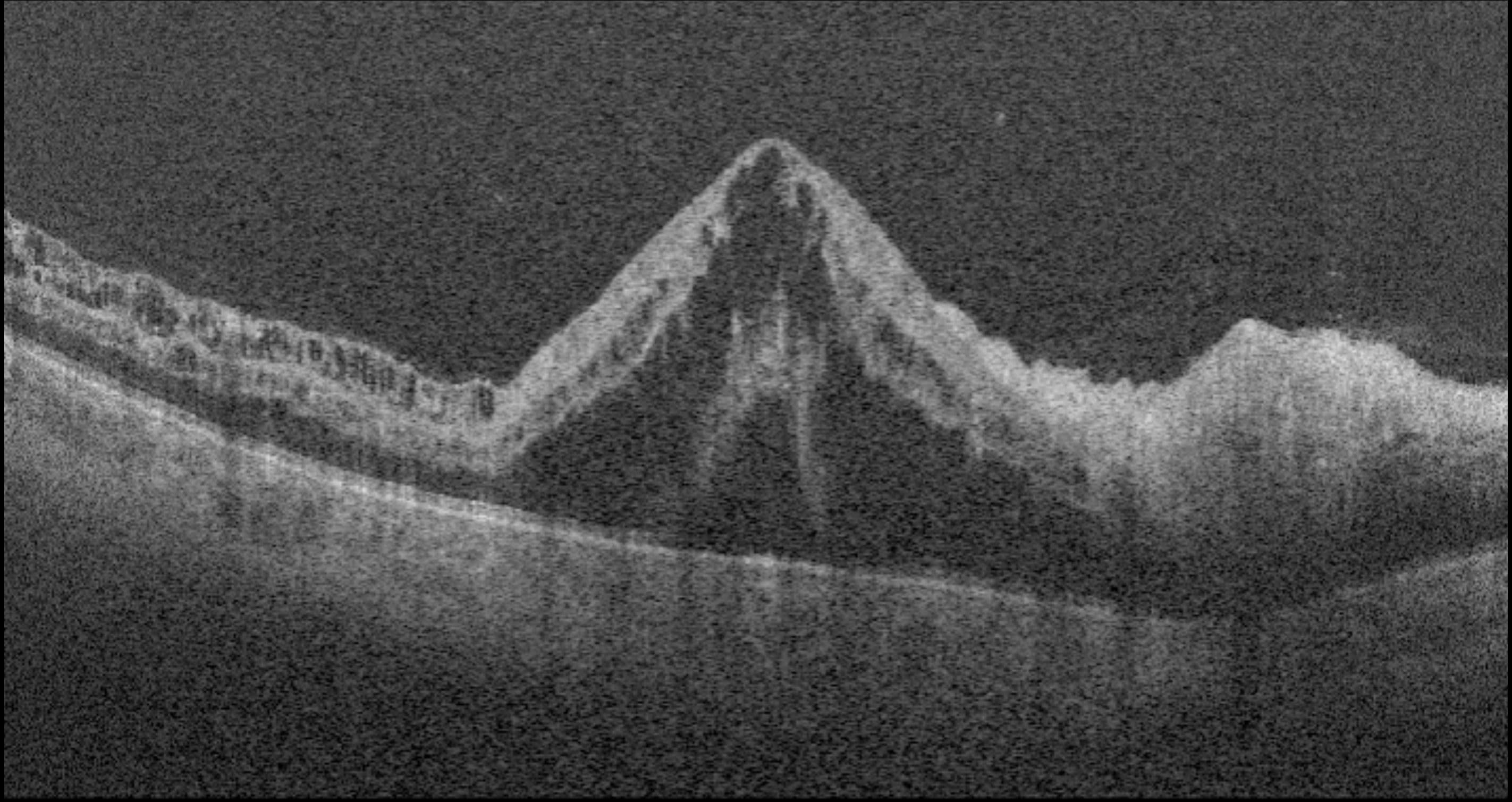 Retinal Rao Oct Advances in the Management of Retinal Vein Occlusion
