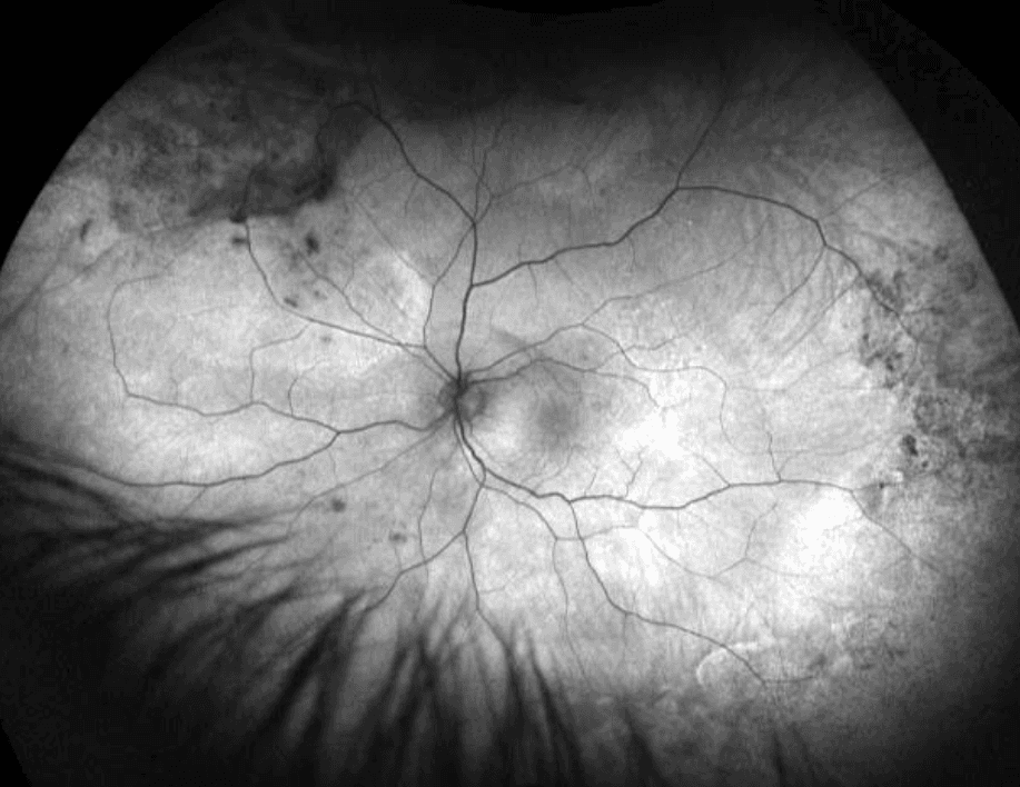 The Wide Spectrum of Peripheral Retinal Disease in AMD