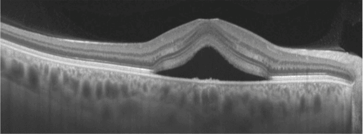 When Testosterone Use Triggers Central Serous Chorioretinopathy