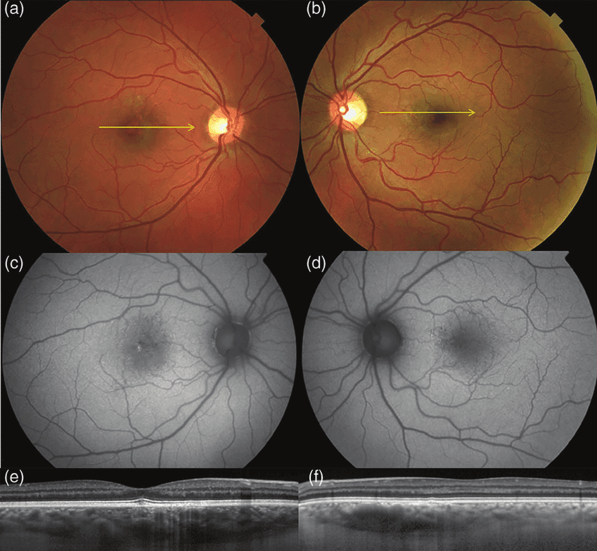 Normal Pachy An Optometrist's Guide to Pachychoroid Spectrum Conditions