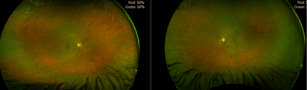 Retina Pattern The OD's Guide to Identifying Peripheral Retinal Disease with Cheat Sheet