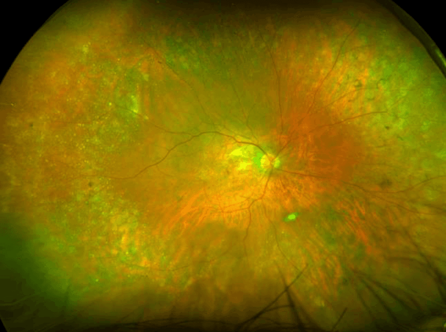 The Wide Spectrum of Peripheral Retinal Disease in AMD