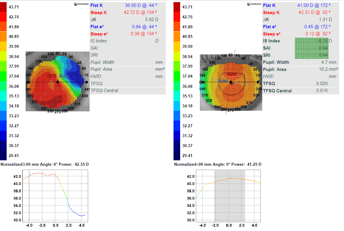 A Case Study on the Role of RGP Lenses in Management of Microcornea
