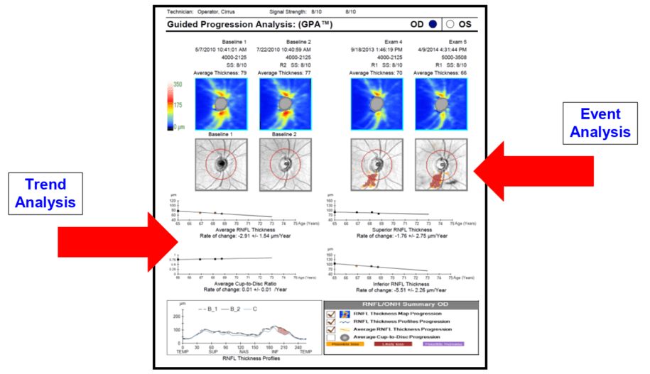 Glaucoma Progression: Putting All the Pieces Together