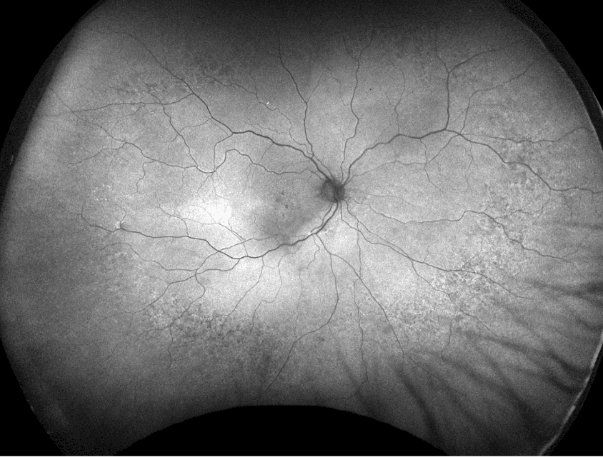 The Wide Spectrum of Peripheral Retinal Disease in AMD