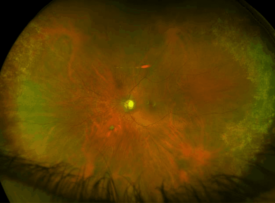 The Wide Spectrum of Peripheral Retinal Disease in AMD