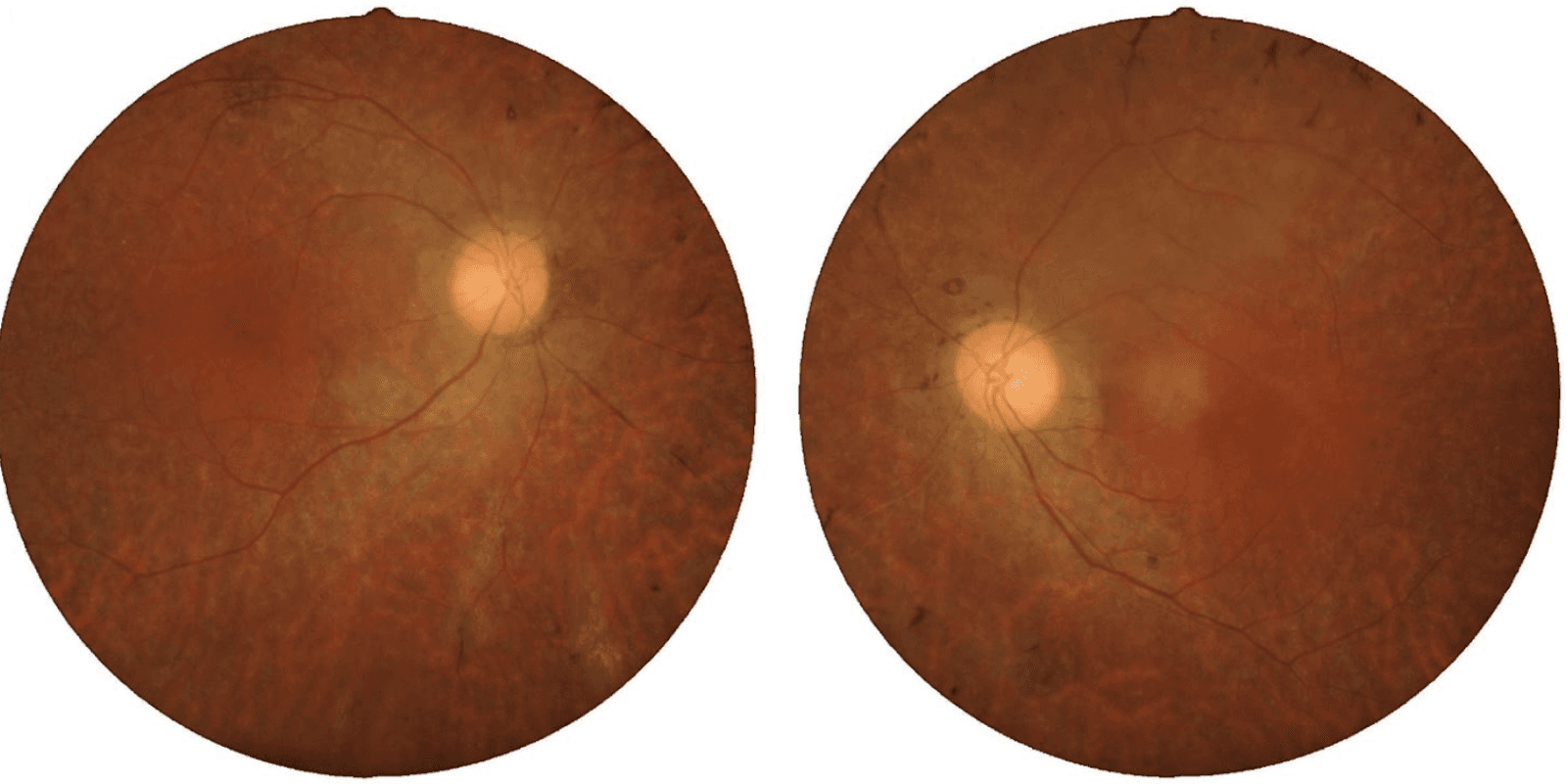 The Ultimate Guide to Identifying Retinal Disease on Fundus Photography