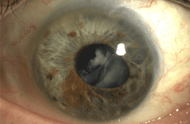 When Photos Mislead: Avoiding Pitfalls of Teleretinal Imaging