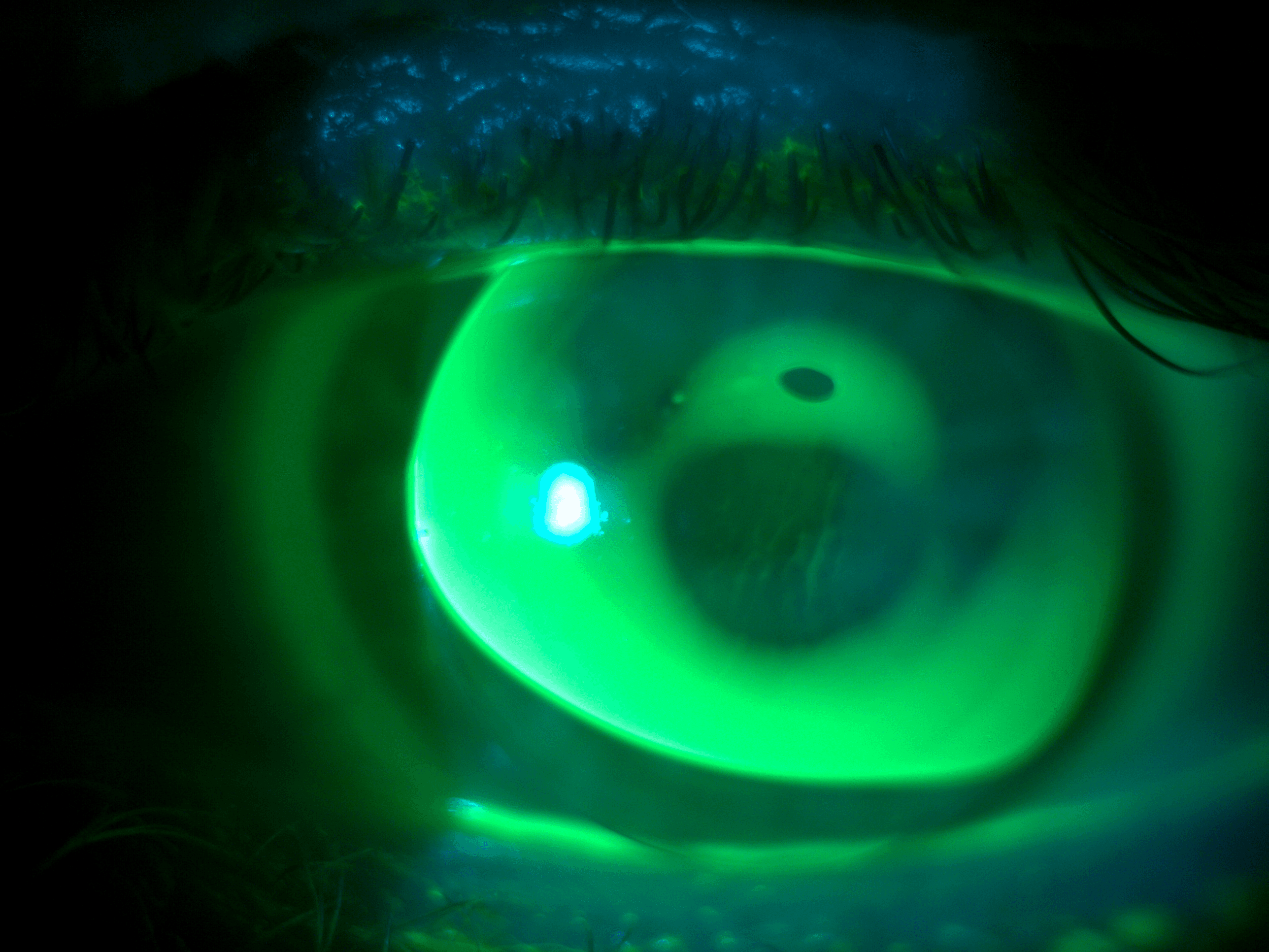 What to Know about Gas Permeable Lenses