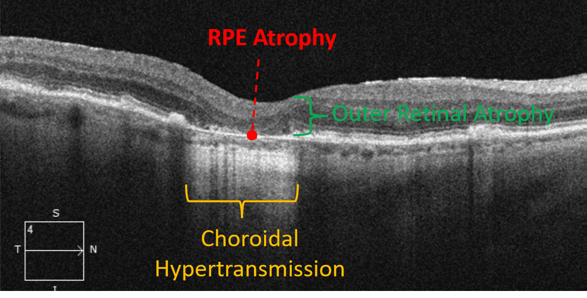 The Optometrist's Guide to Geographic Atrophy
