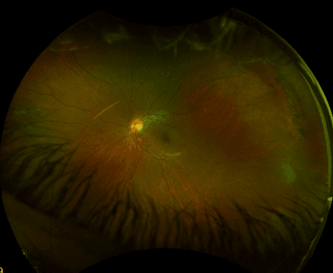 The OD's Guide to Identifying Peripheral Retinal Disease with Cheat Sheet