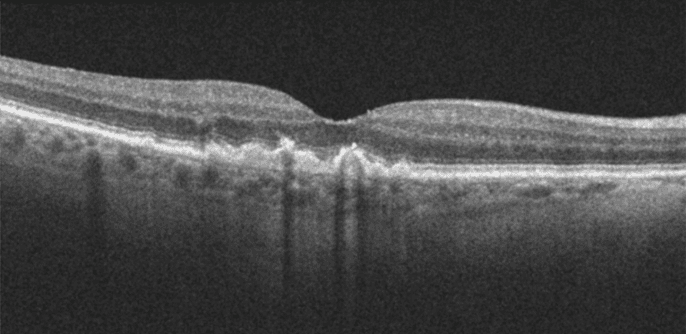 Homonymous Atrophy Oct A New Practice Pattern for Geographic Atrophy
