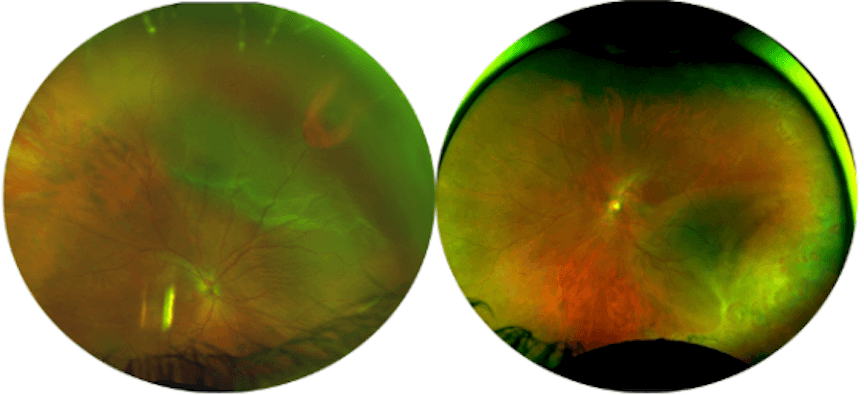 Co Managing Retinal Detachment After Refractive Surgery co-managing-retinal-detachment-after-refractive-surgery
