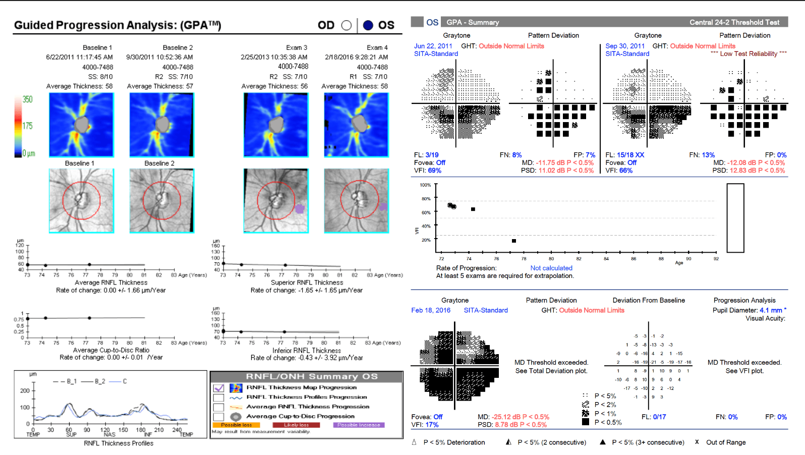 Multi Progression Visual Glaucoma Progression: Putting All the Pieces Together