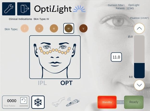 Optilif The Ultimate Guide to OptiLight for Dry Eye