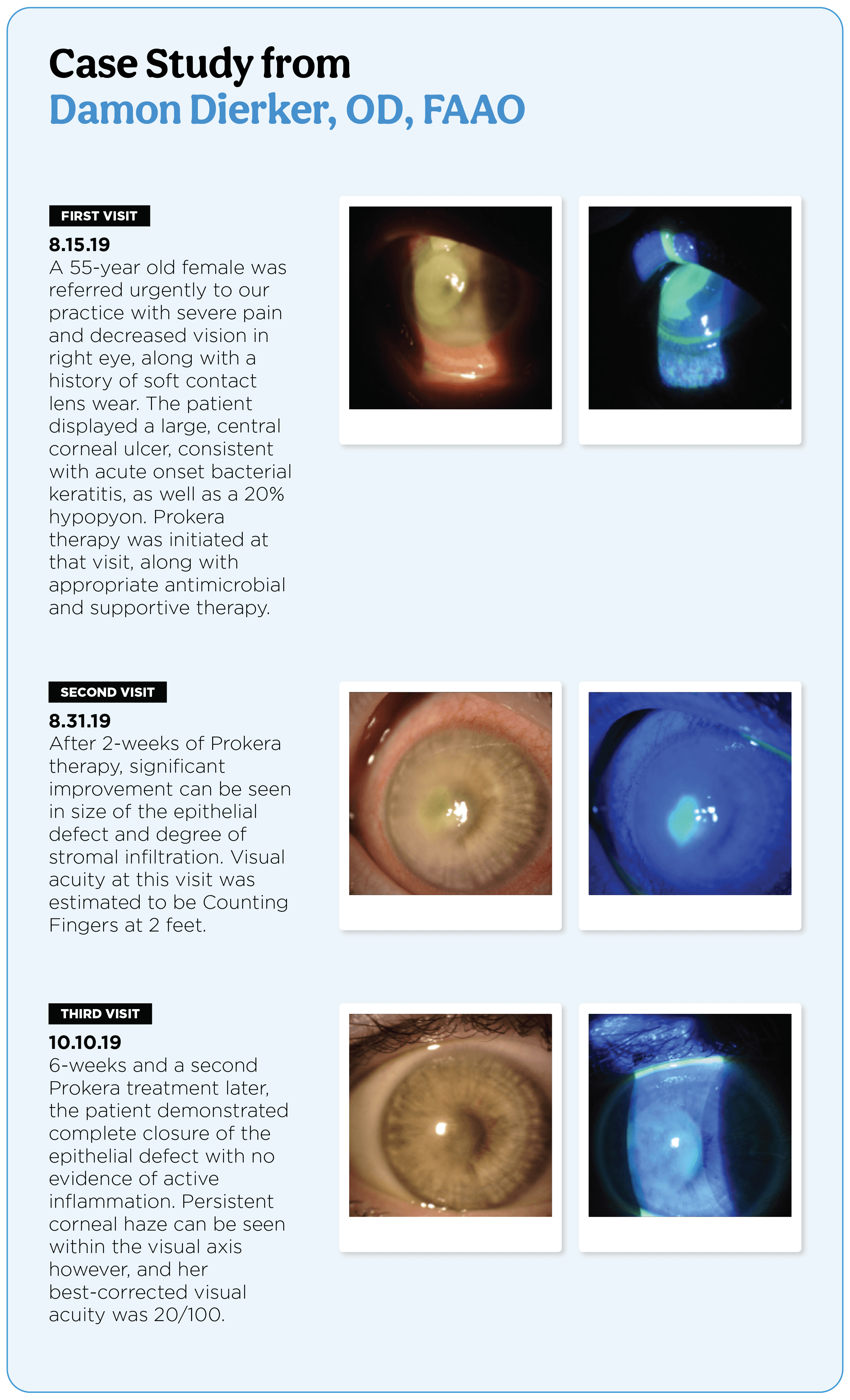 Neox Flo The Ultimate Guide to Prokera® Biologic Corneal Bandages for Ocular ...