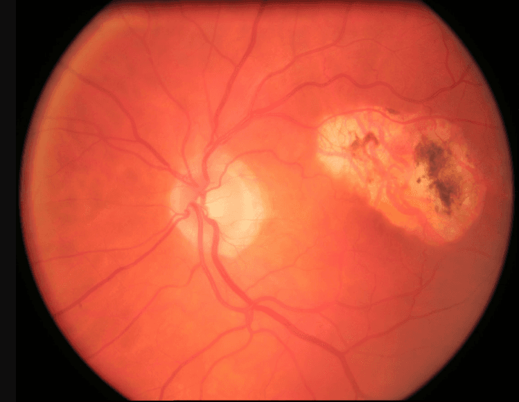 The Ultimate Guide to Identifying Retinal Disease on Fundus Photography