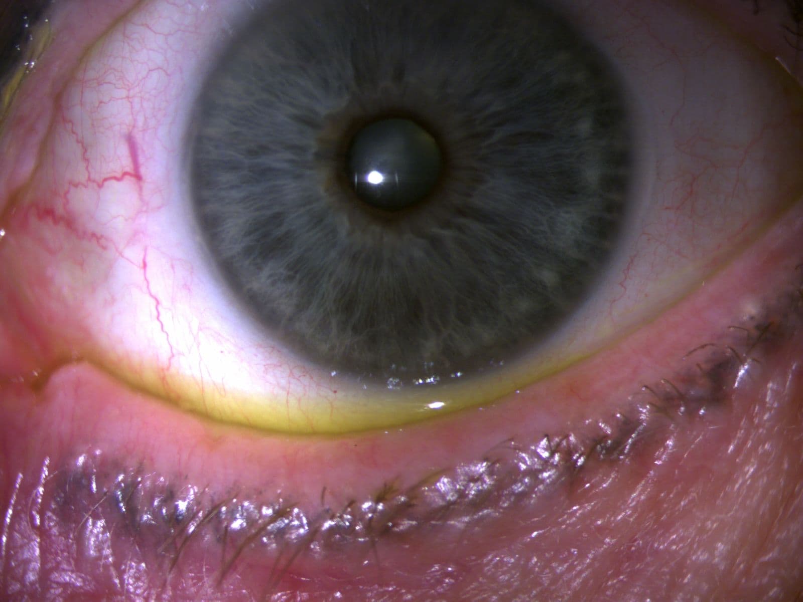 The Ultimate Guide to OptiLight for Dry Eye