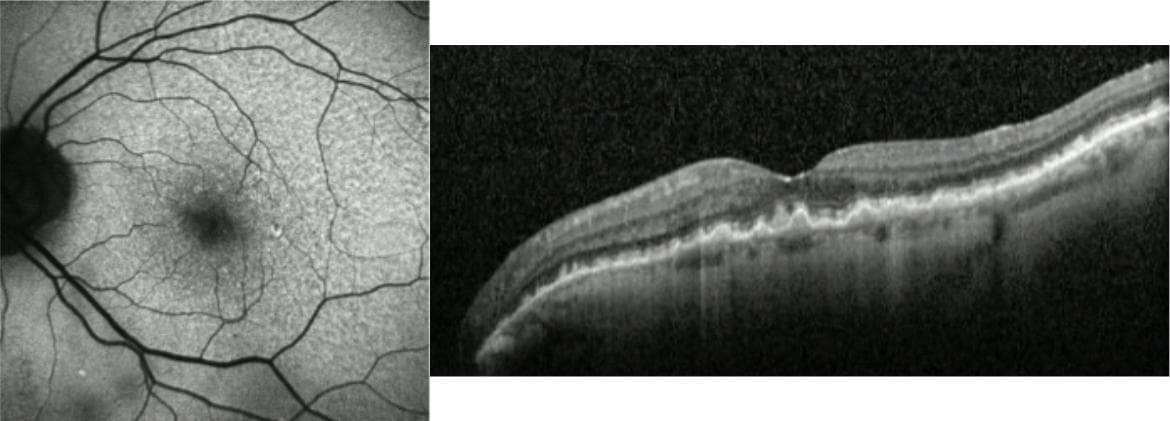 Catching Conversion At Home: Exudative Neovascular AMD
