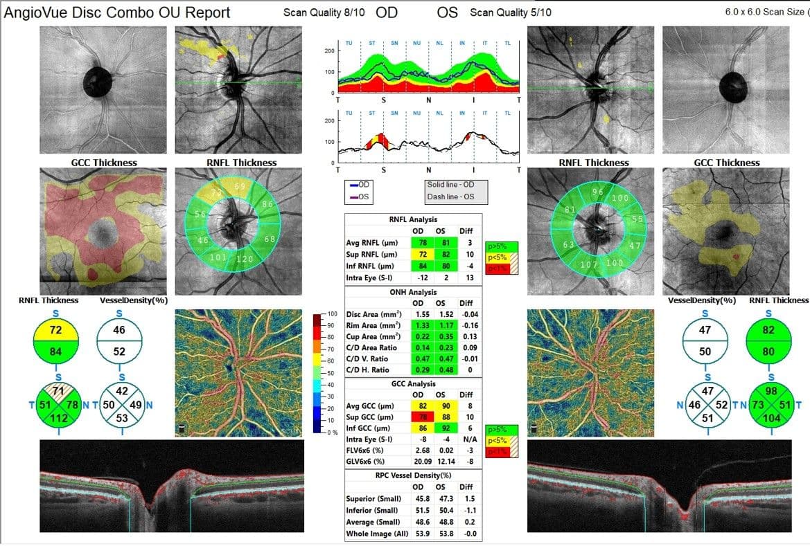 Fields Machine Oct What to Do When Fields and OCT are Inconclusive: A Case Report