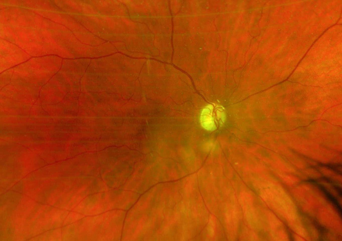 A Guide to Non-Glaucomatous Optic Nerve Disease