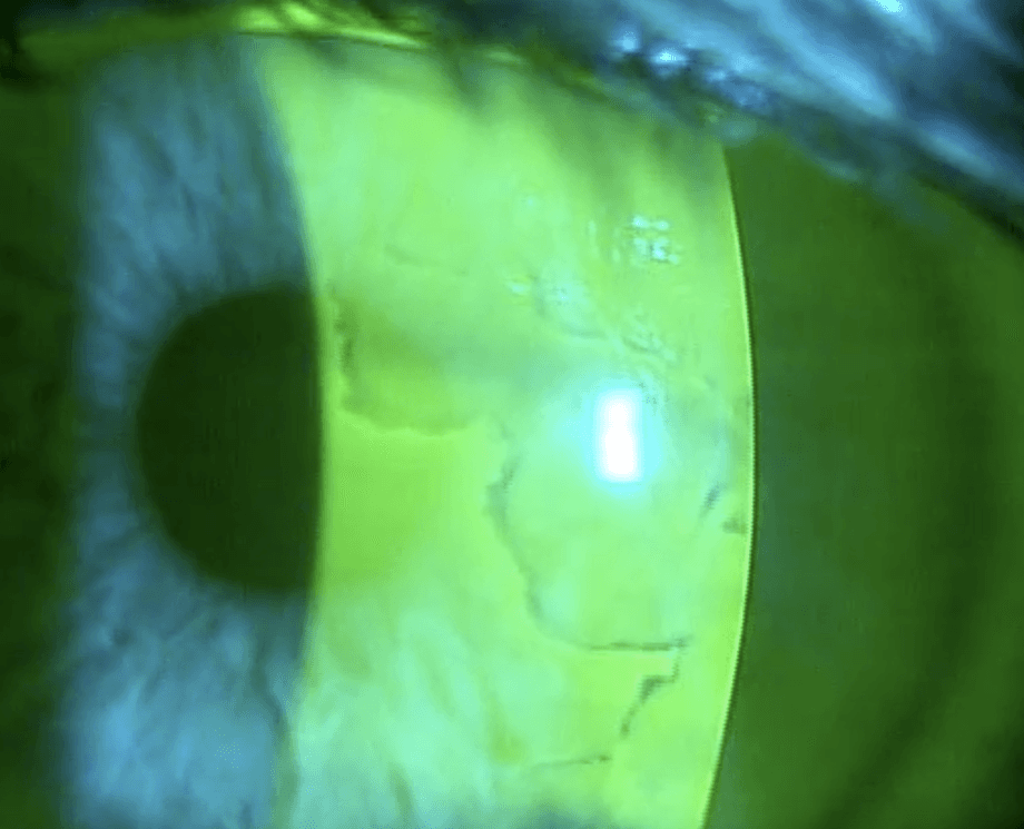 Embd Staining Is It Dry Eye Or Not?